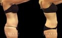 Front and side views of before and after liposuction for female patient. The surgery resulted in a flatter stomach with no notable bulging pockets of fat.