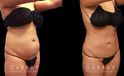 Results of a safe abdominal liposuction surgery that provided this female patient with notable slimming. Note the flat stomach from the profile view with no overhang above the waistline.