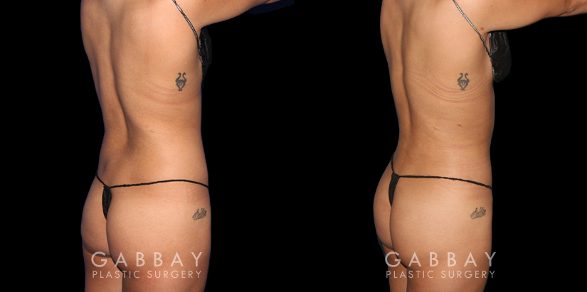 Procedures Depicted:  BBL, Lipo to Abdomen, Waist, and Tailbone, Fat Transfer to Butt. Before-and-after for patient with combined cosmetic surgeries, including BBL, abdominal lipo. Note the 360-degree slimming with enhanced buttocks roundness from the natural fat transfer.