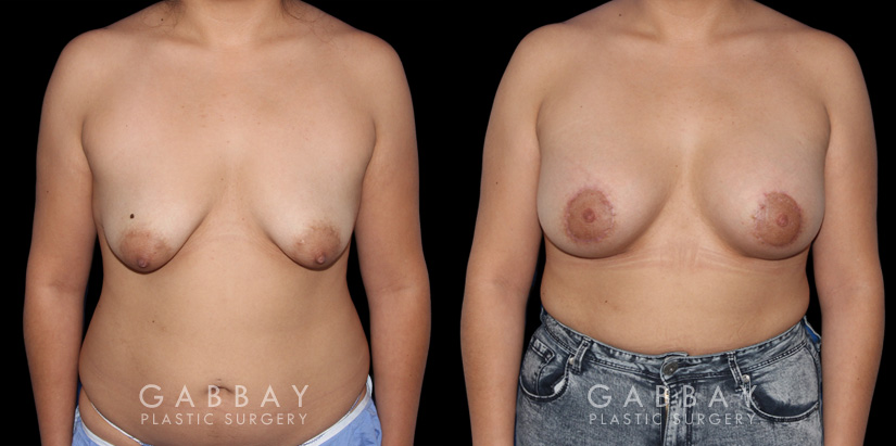 

Procedures Depicted: Breast Augmentation – Silicone & Lift
