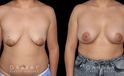 

Procedures Depicted: Breast Augmentation – Silicone & Lift
