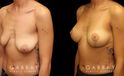 Breast lift combined with breast augmentation using silicone implants. Before-and-after photos demonstrate dramatic aesthetic enhancement of the breasts regarding shape, size, and position. Breast drooping was completely addressed and symmetry was enhanced.