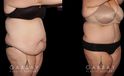 Abdominoplasty patient results, highlighting the loose skin and folds before the procedure. Following surgery, the patient recovered without complications and saw lasting tummy tuck results with a flatter profile.