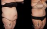 Abdominoplasty patient results, highlighting the loose skin and folds before the procedure. Following surgery, the patient recovered without complications and saw lasting tummy tuck results with a flatter profile.