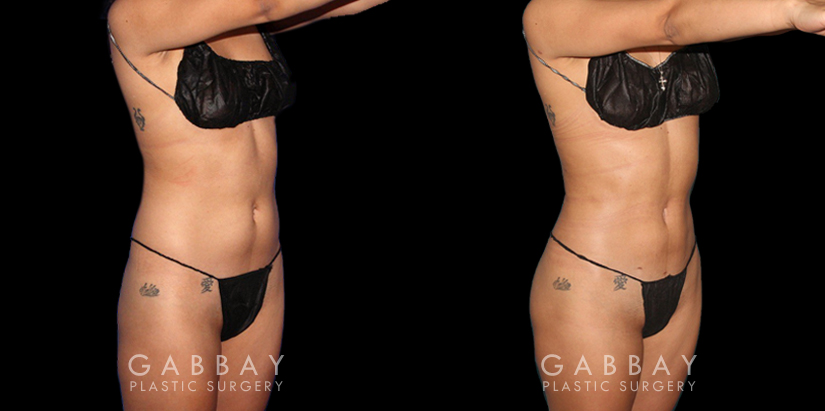 Procedures Depicted:  BBL, Lipo to Abdomen, Waist, and Tailbone, Fat Transfer to Butt. Before-and-after for patient with combined cosmetic surgeries, including BBL, abdominal lipo. Note the 360-degree slimming with enhanced buttocks roundness from the natural fat transfer.