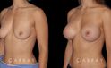 Silicone breast implants results. Note how the breast slope was retained in profile while still achieving a notable bust silhouette.