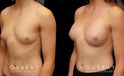 Patient wanted very mild breast augmentation to improve the roundness and curve of breasts. Results show increase from minimal breast shape to a gentle rounding slope to the breasts.