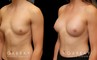 Patient wanted very mild breast augmentation to improve the roundness and curve of breasts. Results show increase from minimal breast shape to a gentle rounding slope to the breasts.