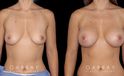 Silicone breast implants results. Note how the breast slope was retained in profile while still achieving a notable bust silhouette.