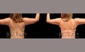 Patient 04 Back View Crecent Arm Lift, Liposuction to Arms, J Plasma to Arms Gabbay Plastic Surgery