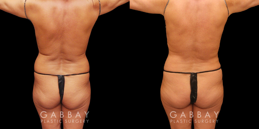 Procedures Depicted:  liposuction and j plasma to full abdomen Female African-American patient after liposuction and J plasma treatment to her full abdomen, reducing her bulging belly and to tighten and restore loose skin.