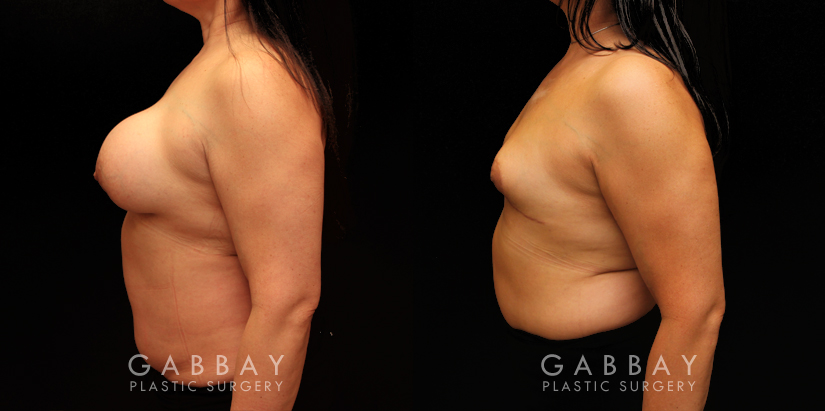 Procedures Depicted:  Auto Augmentation with lift