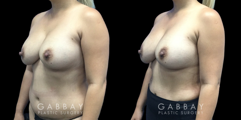 Patient 13 Front View Breast Fat Grafting Gabbay Plastic Surgery