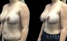 Patient 13 Front View Breast Fat Grafting Gabbay Plastic Surgery