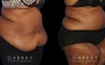 Patient photos showing before and after abdominoplasty procedure. Before surgery, the patient had significant banding and loose skin over the abdomen. Following liposuction to multiple areas combined with surgical excision of excess skin, the final result is a tighter, firmer look.