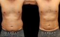 Male liposuction results after reducing stubborn belly fat that would not respond to diet or exercise. The belly area went from significant overhang above the beltline to a flatter contour.