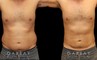 Male liposuction results after reducing stubborn belly fat that would not respond to diet or exercise. The belly area went from significant overhang above the beltline to a flatter contour.