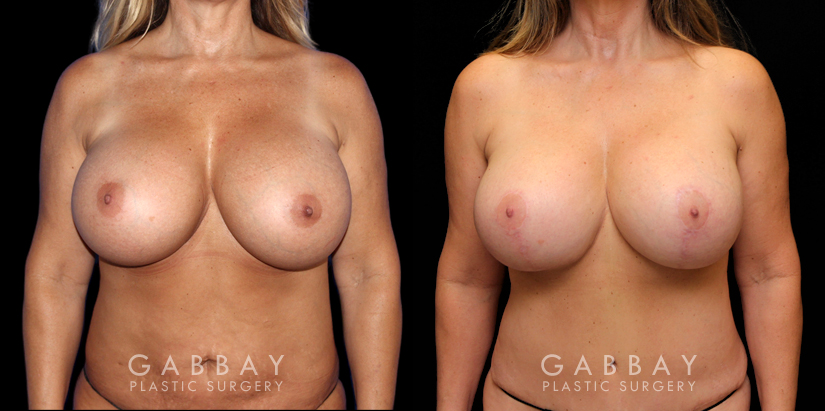 Procedures Depicted:  Abdominoplasty