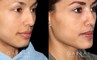 Patient 01 3/4th Right Side View Chin implant, Rhinoplasty, BAM Gabbay Plastic Surgery