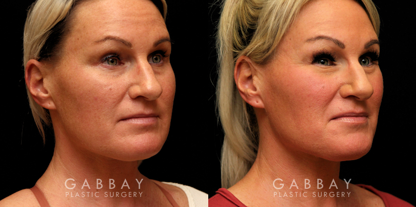 Procedures Depicted:  Buccal Fat Pad Removal