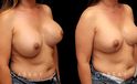 Patient 10 3/4th Right Side View Removal and Replacement with Lift Silicone Implants Gabbay Plastic Surgery