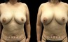 Patient 10 Front View Breast Fat Grafting Gabbay Plastic Surgery