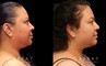 Procedures Depicted:  Chin/Neck Liposuction