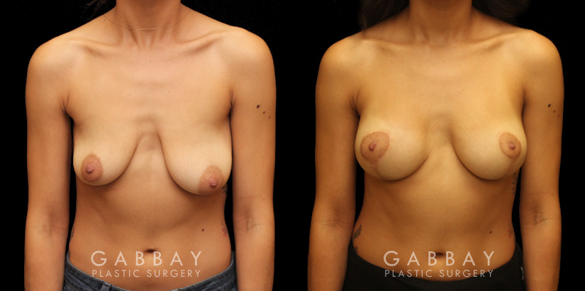 Procedures Depicted:  Augpexy with mesh