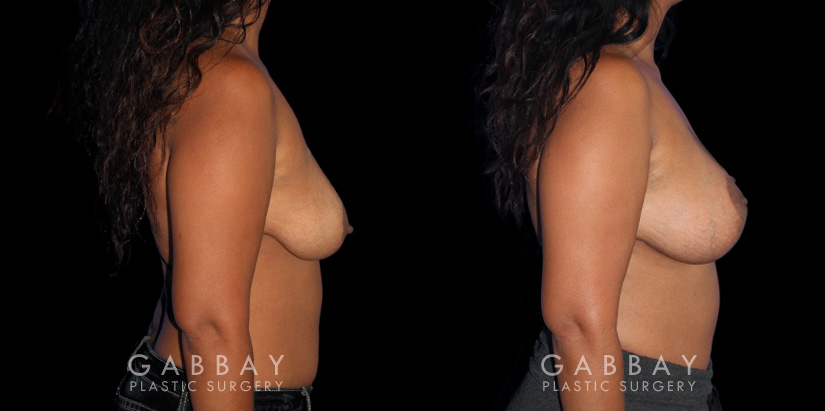 Procedures Depicted:  Wise Mastopexy with Silicone Breast Implants
