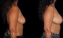 Procedures Depicted:  Wise Mastopexy with Silicone Breast Implants