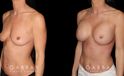 Patient breasts with silicone implants following complete recovery. Now how the incisions are hidden in the breast folds, making them invisible from most angles.
