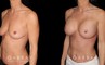Patient breasts with silicone implants following complete recovery. Now how the incisions are hidden in the breast folds, making them invisible from most angles.