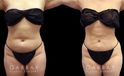 Abdominal liposuction results for a Caucasian patient who wanted to address pockets of belly fat that would not go away. The procedure removed the fat and produced a flat profile with a tighter tummy appearance.