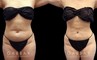 Abdominal liposuction results for a Caucasian patient who wanted to address pockets of belly fat that would not go away. The procedure removed the fat and produced a flat profile with a tighter tummy appearance.