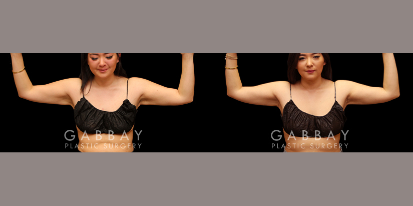 Patient 05 Back View Crecent Mini Arm Lift Gabbay Plastic Surgery