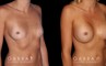 Breast augmentation before-and-after photos for patient with silicone implants. Increased volume resulted in pleasantly round breasts without excessive change.