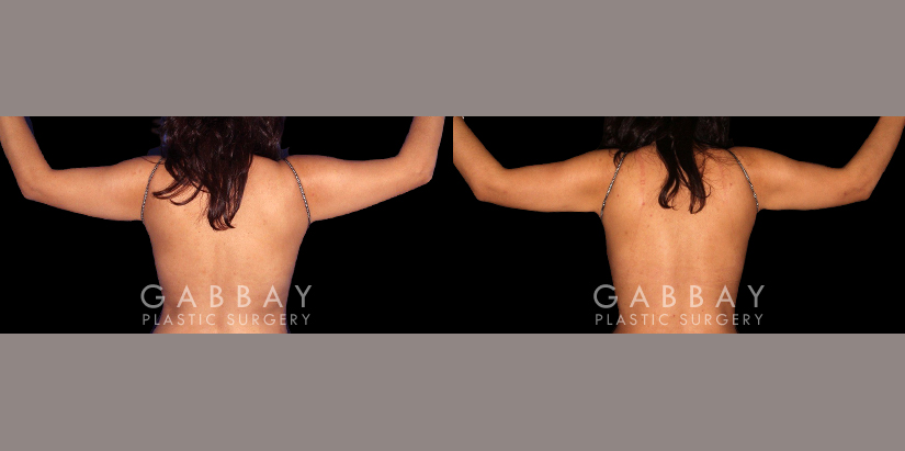 Procedures Depicted:  Abdominoplasty, Lipo to Waist and Arms.