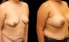 Silicone implant results. Patient increased breast size and used the implants to reduce breast drooping as well, without the need for mastopexy in addition.