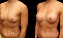 Patient photos showing before and after her breast augmentation procedure, with notable breast size increase while maintaining a balanced aesthetic.