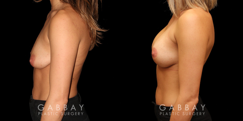 Procedures Depicted:  Mastopexy with Breast Augmentation
