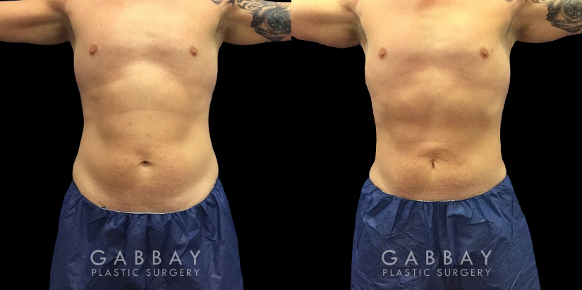 Active male patient wanted to target stubborn belly fat that would not disappear with exercise. Abdominal liposuction allowed him to achieve his target body shape and figure.