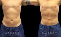 Active male patient wanted to target stubborn belly fat that would not disappear with exercise. Abdominal liposuction allowed him to achieve his target body shape and figure.