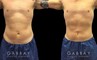 Active male patient wanted to target stubborn belly fat that would not disappear with exercise. Abdominal liposuction allowed him to achieve his target body shape and figure.