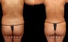 Procedures Depicted:  Liposuction-waist,abdomen,tail bone, back bra roll