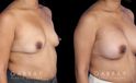 Patient before and after silicone implants with complete, uncomplicated recovery. Volume increase is notable while also improving the balance between breasts without resorting to unnatural perfect symmetry.