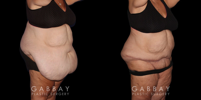 Patient 01 Right Side View Abdominal Panniculectomy Gabbay Plastic Surgery