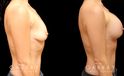 Patient with combined areola lift and breast augmentation, photos showing her before and after the procedure. Not the improved breast position and increased volume.
