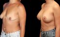 Procedures Depicted:  Breast Augmentation w/ Mastopexy – Silicone