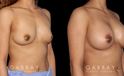 Silicone implant results for female patient in her 30s. Mild increase to volume allowed for balanced results that match her natural body contours.