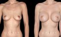 Saline breast augmentation results. Note how the breasts increased several cup sizes in volume while still balancing with the patient’s natural body shape. Breast slope is mild with impression protrusion in the silhouette.